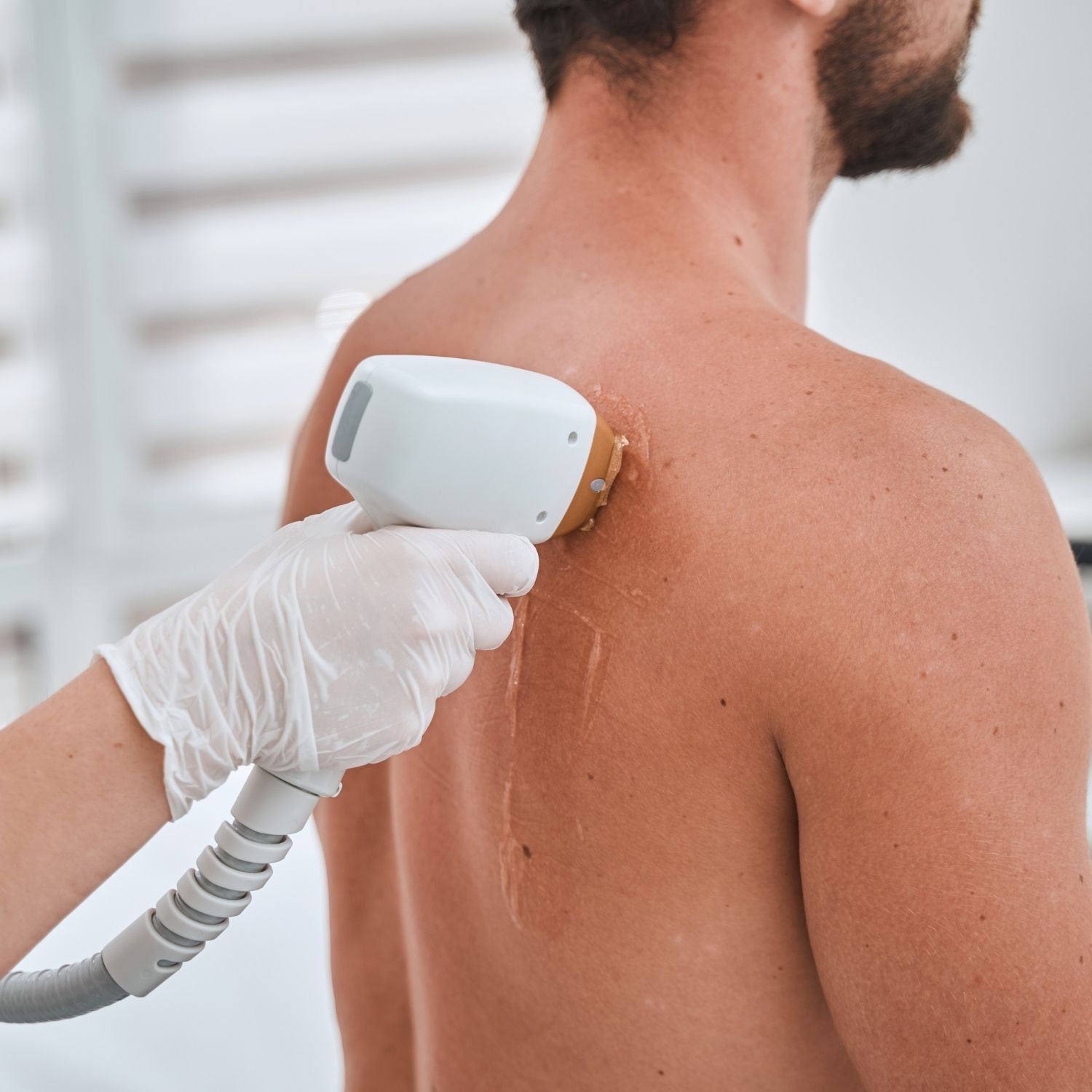 Laser hair removal on man's back